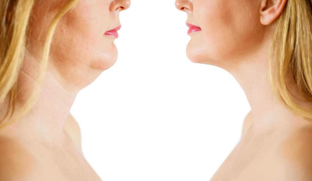 Double Chin treatment Waltham's Cross before and after results