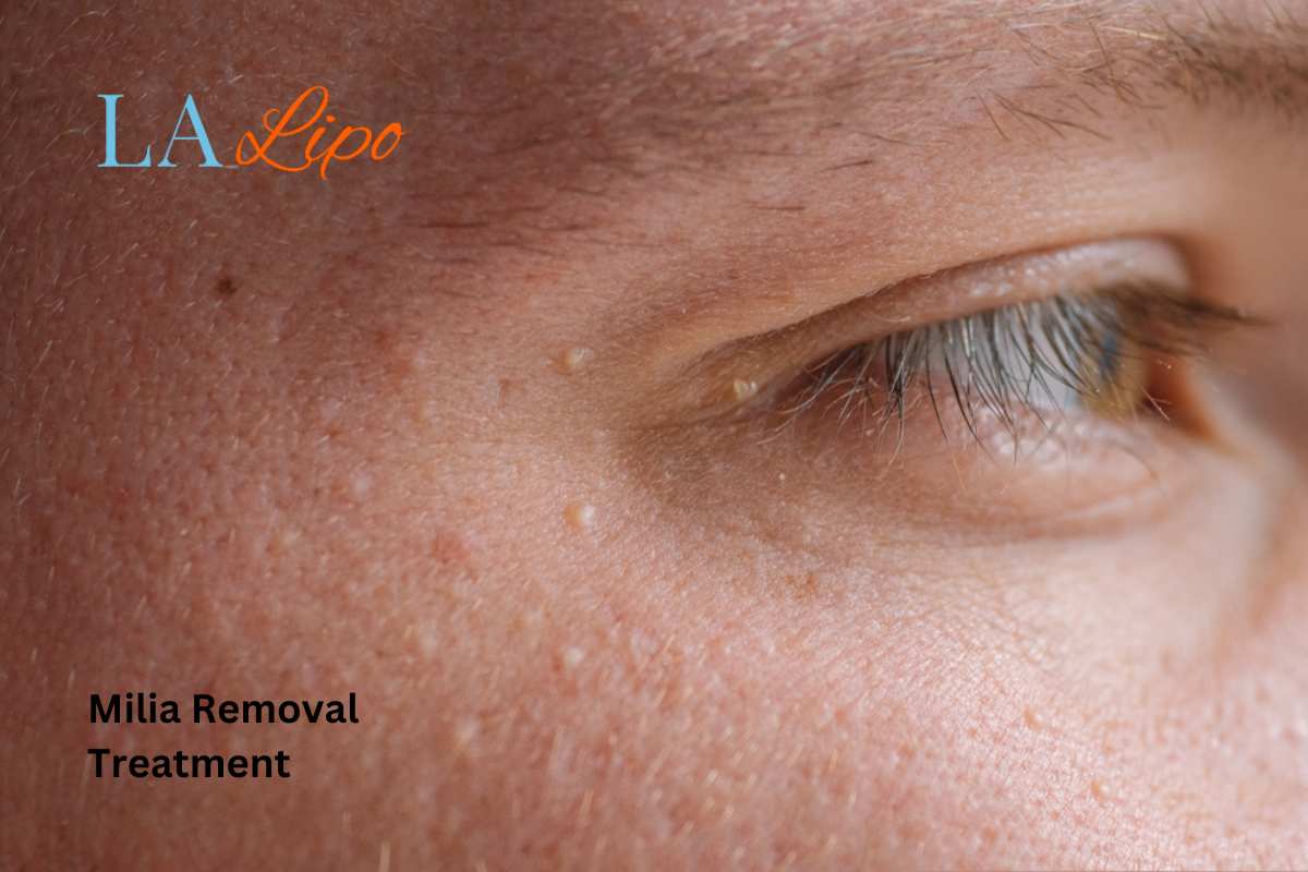 Cryopen Milia Removal: Is It the Easiest and Safest Option Waltham's Cross?