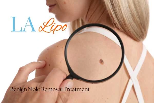 Why getting moles removed Waltham's Cross can boost your confidence!