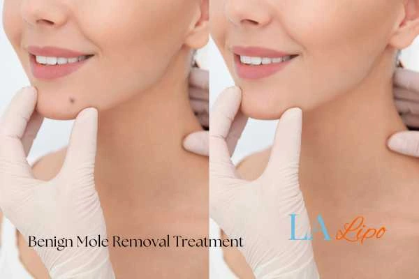 Woman's before and after results of being moles removal treatment Waltham's Cross