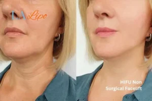 hi-fu for wrinkles Waltham's Cross before and after results