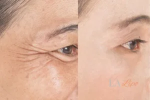 Before and after results of woman - HI-fu wrinkles reduction treatment Waltham's Cross