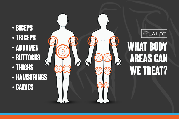 Graphic to show areas you can have LA-EMS Body Sculpting Waltham's Cross treatment.