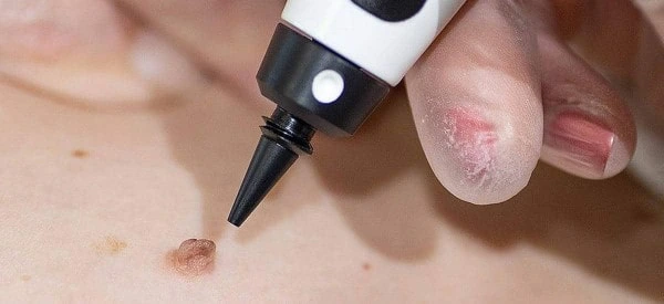 skin tag removal using cryopen Waltham's Cross