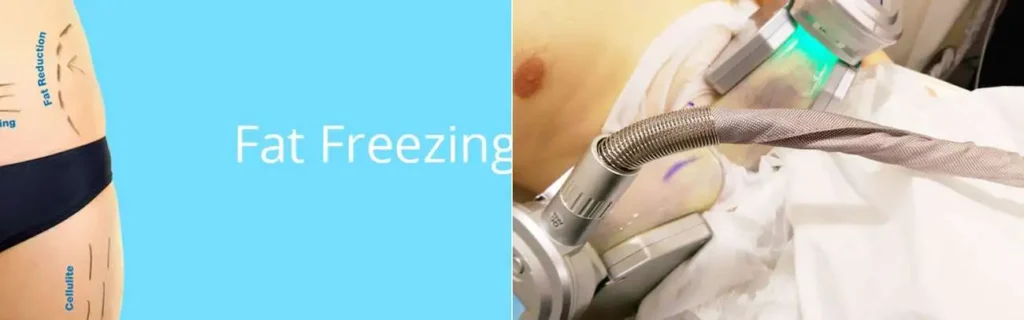 Fat freezing Waltham's Cross on multiple areas of the body