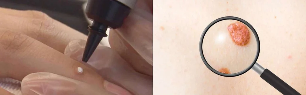 Person getting moles removed with cryopen Waltham's Cross