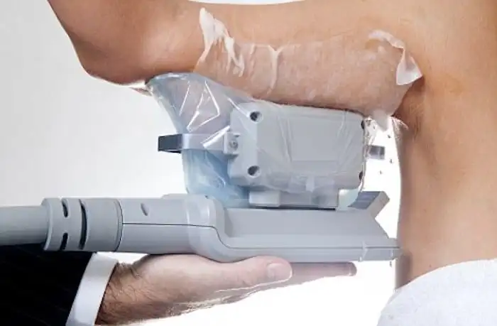 Picture of fat freezing Waltham's Cross on the upper arms.