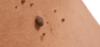 image of a skin tag Waltham's Cross
