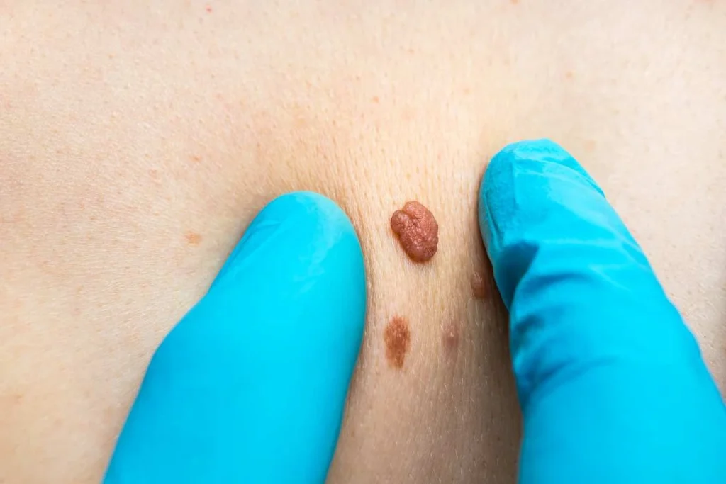 Consultant examining a skin tag Waltham's Cross