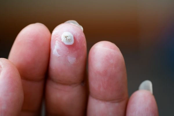 wart on person finger - cryotherapy to treat from LA LIPO Waltham's Cross