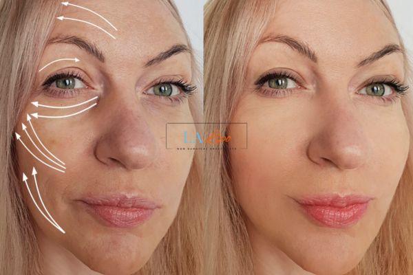 Morpheus 8 results Waltham's Cross face lift.