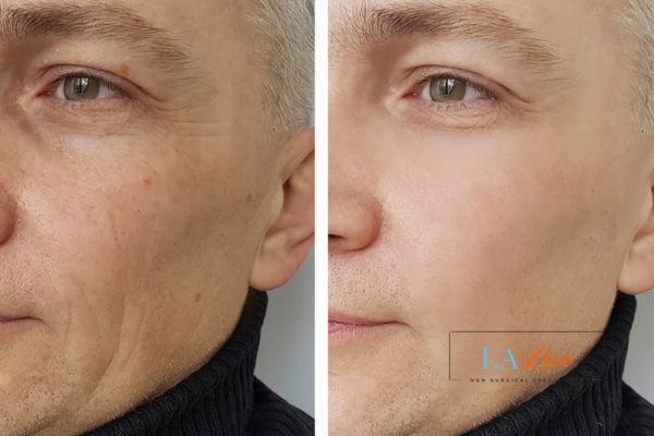 See the amazing results of Morpheus8 Treatment Waltham's Cross!