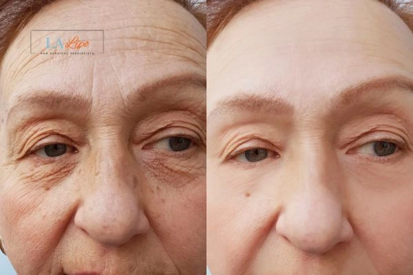 The powerful benefits of Morpheus8 Treatment Waltham's Cross - Call Our team today!