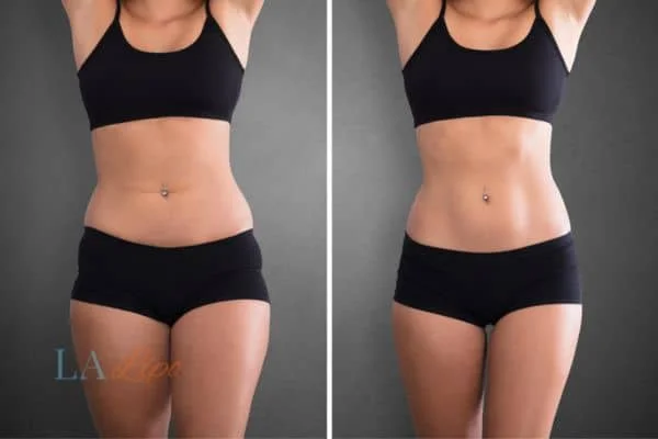 before and after results of non-surgical treatment to help a woman's body image and mental health Waltham's Cross