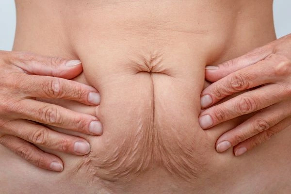 Image of a woman's stomach with loose skin - example of skin tightening Waltham's Cross options