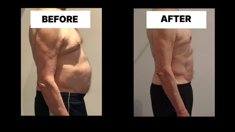 What Symptoms Can Diastasis Recti Cause in Men? Weak Core, Back Pain and Poor Posture Waltham's Cross